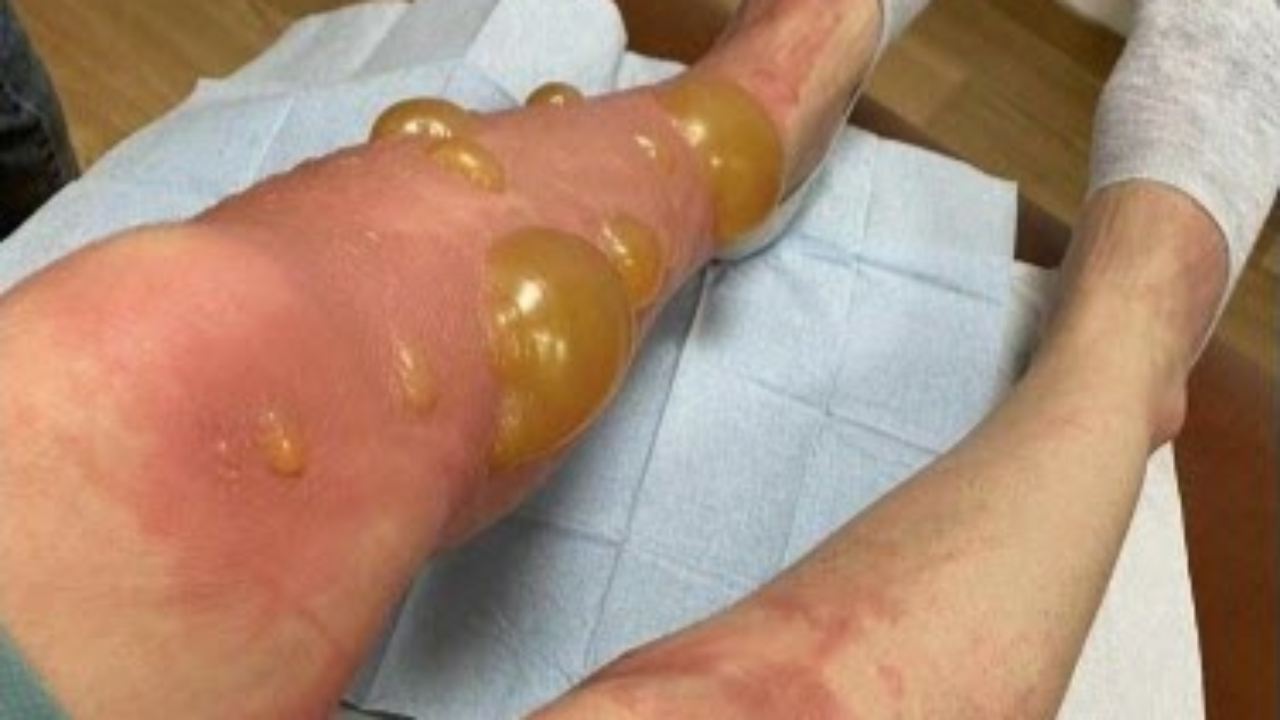 Lac du Bourget : l'hôpital de Chambéry explique la réaction phototoxique